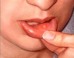 canker-tiens-1216219576[1].jpg