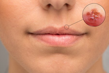 herpes1.jpg