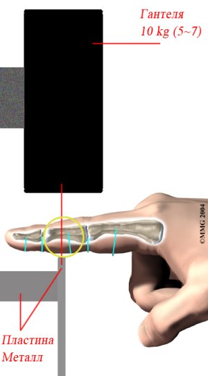 Injury-finger crack 2010.jpg