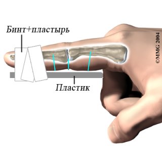 Injury-finger crack 2010 - aid.jpg