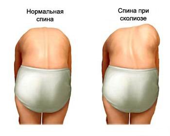skolioz3.jpg