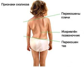 scoliosis.jpg