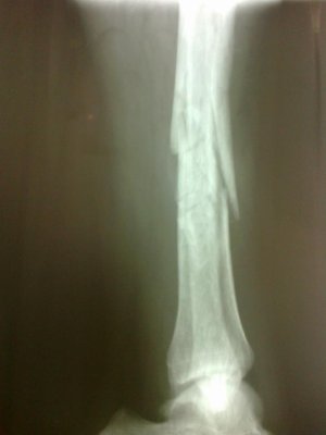 tashi fracture 1.jpg
