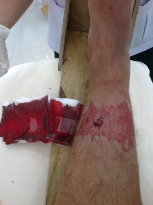tashi fracture 3.jpg