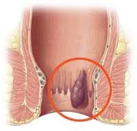 vnutrenniy-gemorroy.jpg