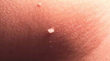papilloma.jpg papilloma.jpg