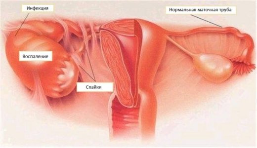 piosalpinks-728x420 (1).jpg