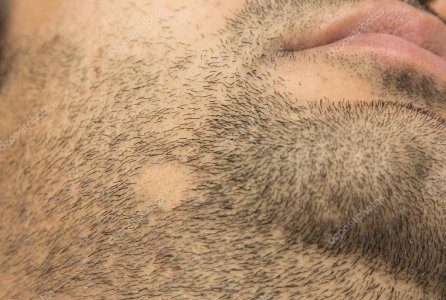 depositphotos_35512187-stock-photo-alopecia-areata-hair-loss-on.jpg