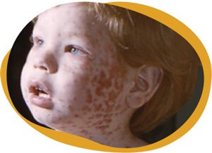 Measles-3.jpg