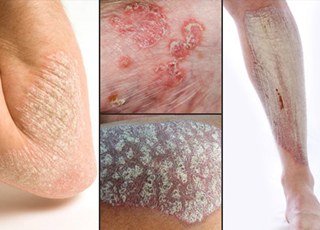 Psoriaz-prichiny-vozniknoveniya-simptomy-i-priznaki-diagnostika-i-lechenie_big.jpg
