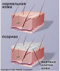 1psoriaz.jpg 1psoriaz.jpg