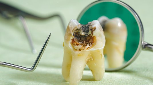 Fighting-Dental-Caries-and-Beyond.jpg