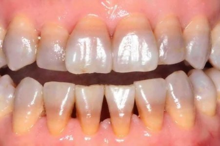 tetracycline_teeth.jpg