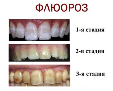 флюороз.jpg