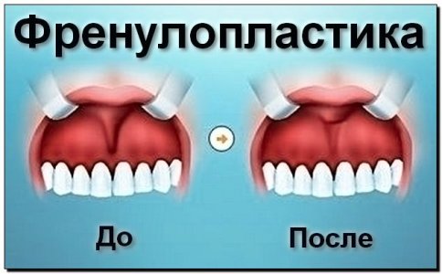 Френулопластика.jpg