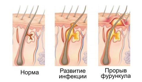 Фурункул и фурункулез.jpg
