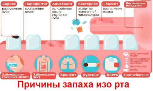 Галитоз.jpg