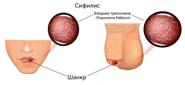 сифилис.jpg