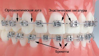 Ортодонтические лигатуры.jpg