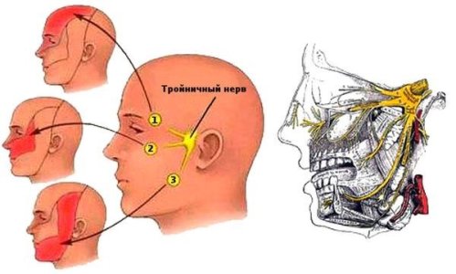 Невралгия тройничного нерва.jpg