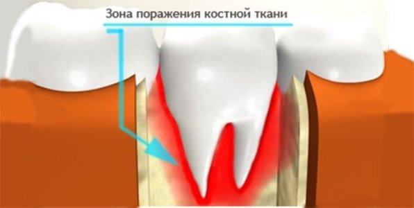 Остеомиелит челюсти.jpg