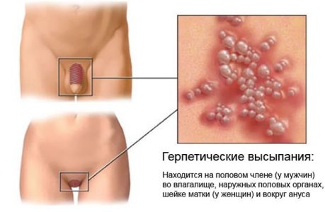 Герпес.jpg