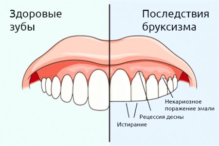 Бруксизм.jpg