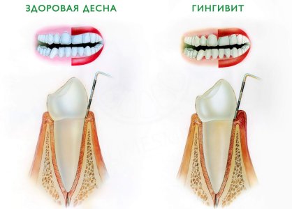Гингивит.jpg