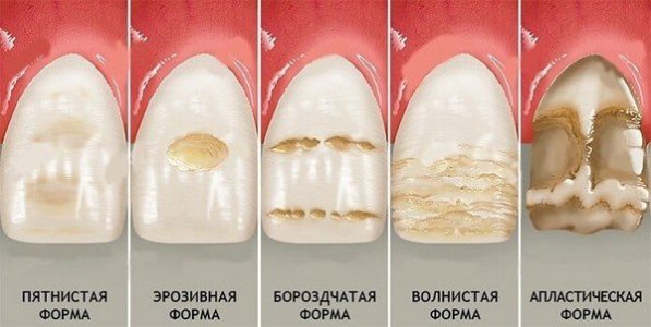 Гипоплазия эмали.jpg