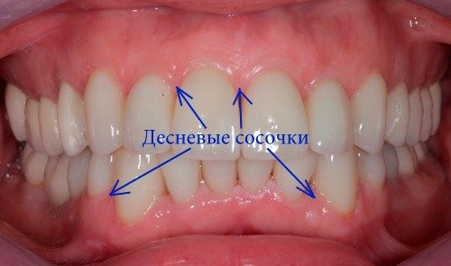 Десневой сосочек.jpg