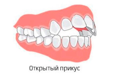 Открытый прикус.jpg