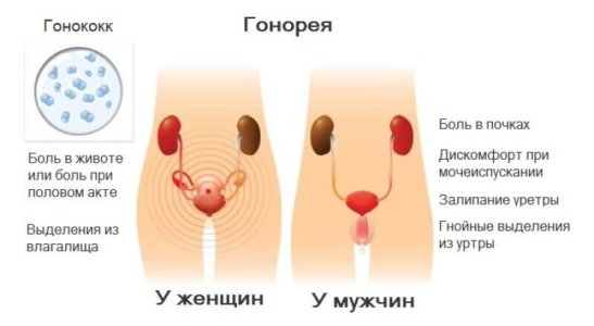 Гонорея.jpg