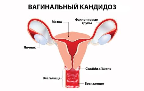 Кандидоз.jpg