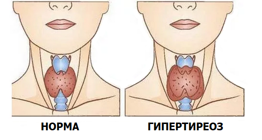 Гипертиреоз.png