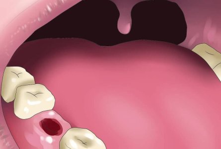 alveoli.jpg