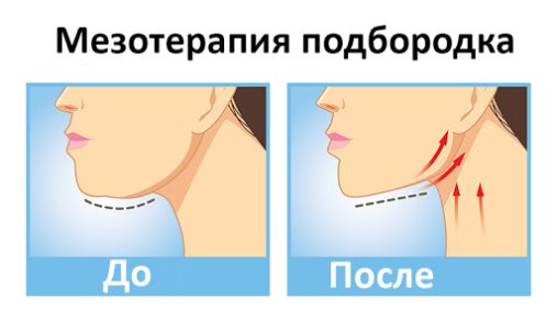 Мезотерапия как средство борьбы со вторым подбородком.jpg