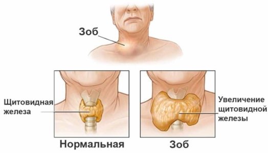 зоб.jpg