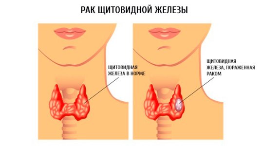 Рак щитовидной железы.jpg