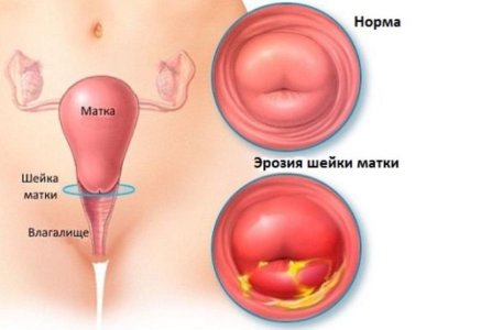 Эрозия шейки матки.jpg