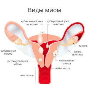 Миома матки.jpg