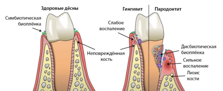 vospaleniedesnii.png
