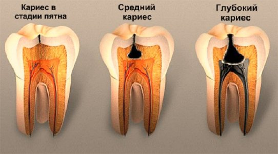виды-кариеса.jpg