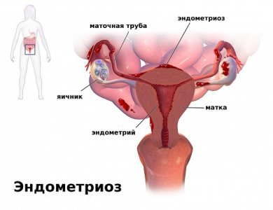 Эндометриоз.jpg