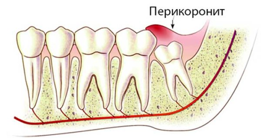 perekoronarit.png