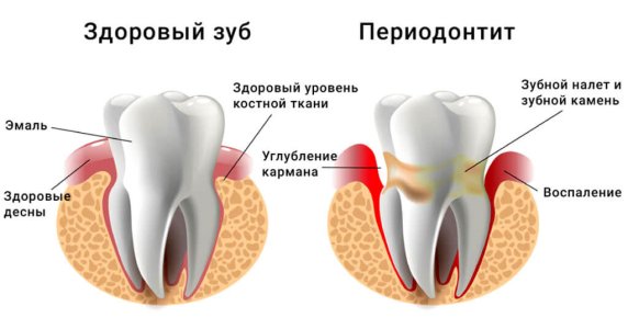 periodontit-lechenie-v-moskve.jpg