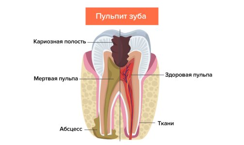 pulpit_trehkanalnogo_zuba-.jpg