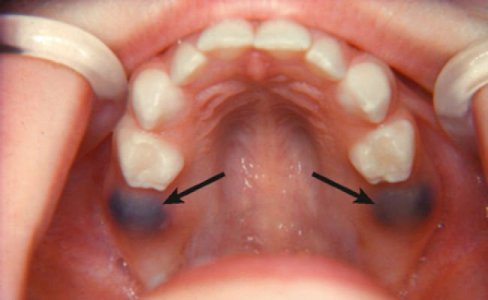 gematoma-posle-udaleniya-zuba-lechenie2.jpg