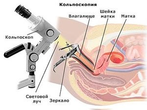 Кольпоскопия шейки матки.jpg