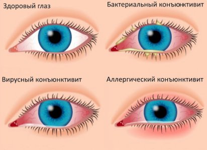 Конъюнктивит.jpg