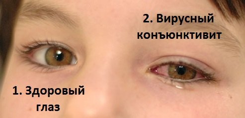Вирусные конъюнктивиты.jpg